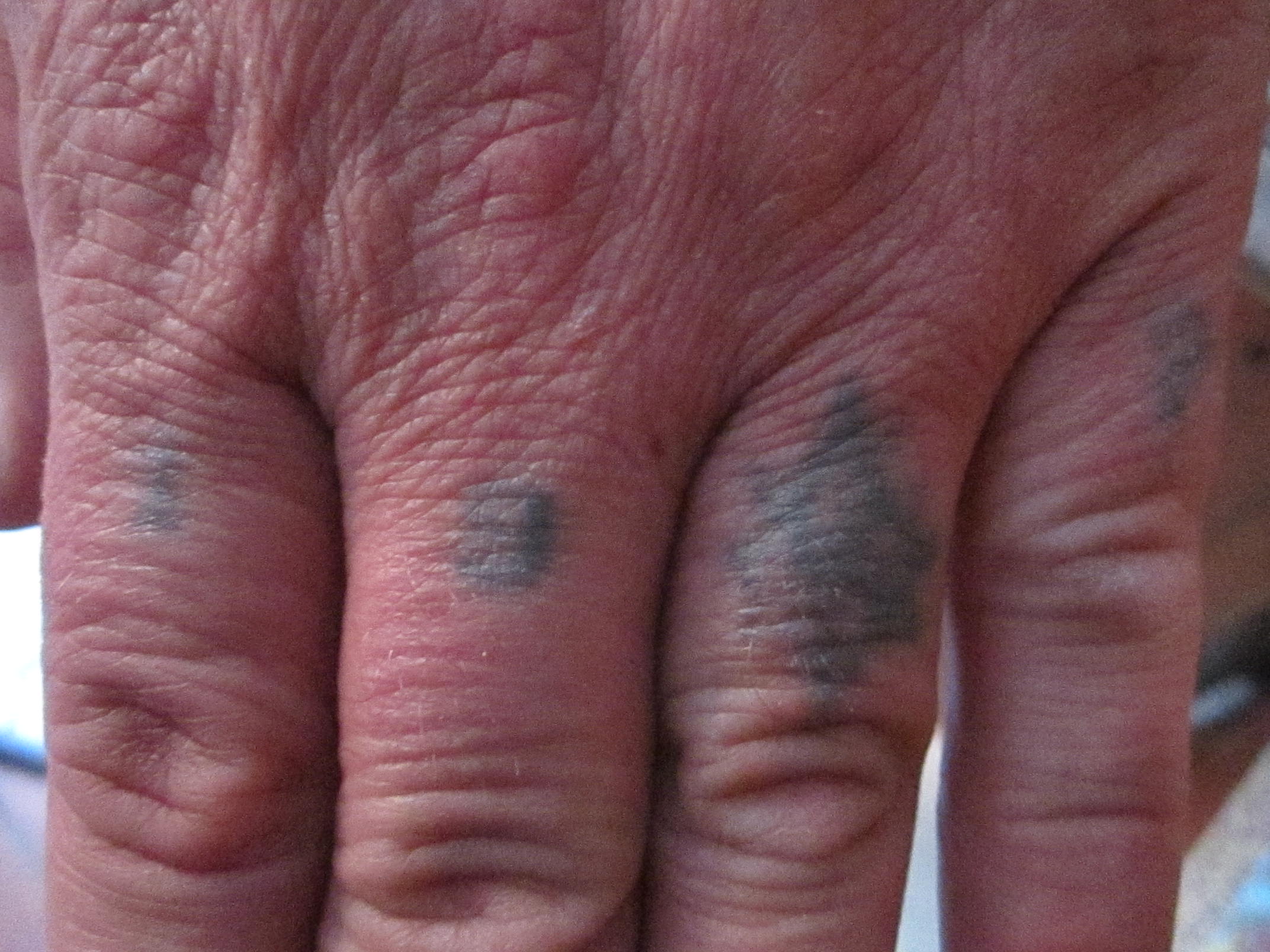 Nach 1 Jahr Finger Tattoo Vorher Nachher Tattoo-Entfernung - ToroBravo